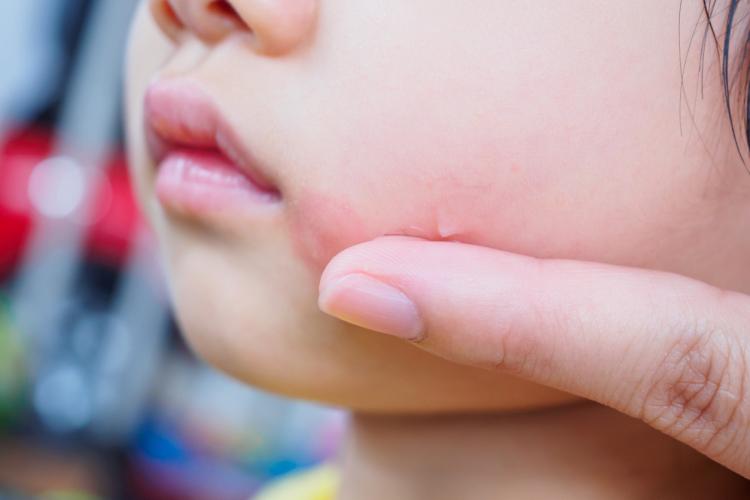 Mengenal Alergi Dingin Pada Anak, Ibu Wajib Tahu